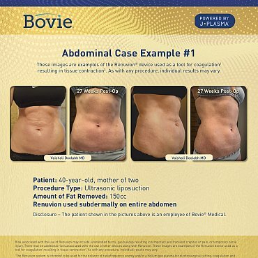 renuvion-before-after-abdominal-case-no1_mm0131-01_111518