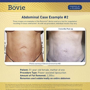 renuvion-before-after-abdominal-case-no2_mm0151-01_111518