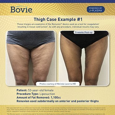 renuvion-before-after-thigh-case-no1_mm0155-02_111518