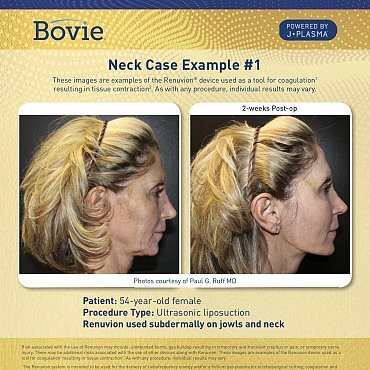 renuvion-before-after-neck-case-no1_mm0150-01_111518