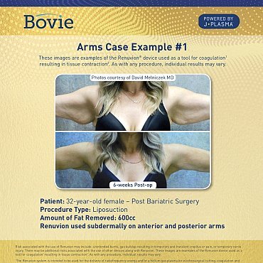 renuvion-before-after-arms-case-no1_mm0156-01_111518