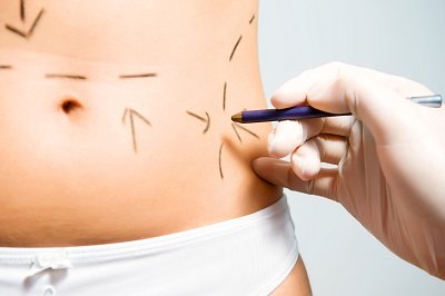 All about liposuction