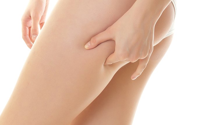 How to get rid of stretch marks: laser treatment or mesotherapy ❒ Studio Romano Fuhr