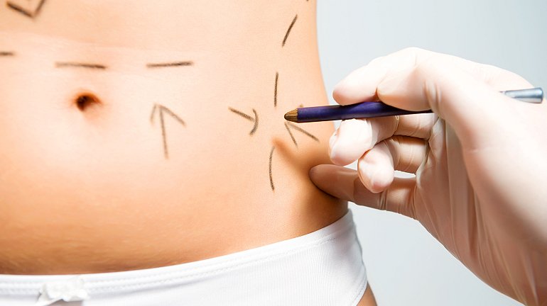 All about liposuction ❒ Studio Romano Fuhr